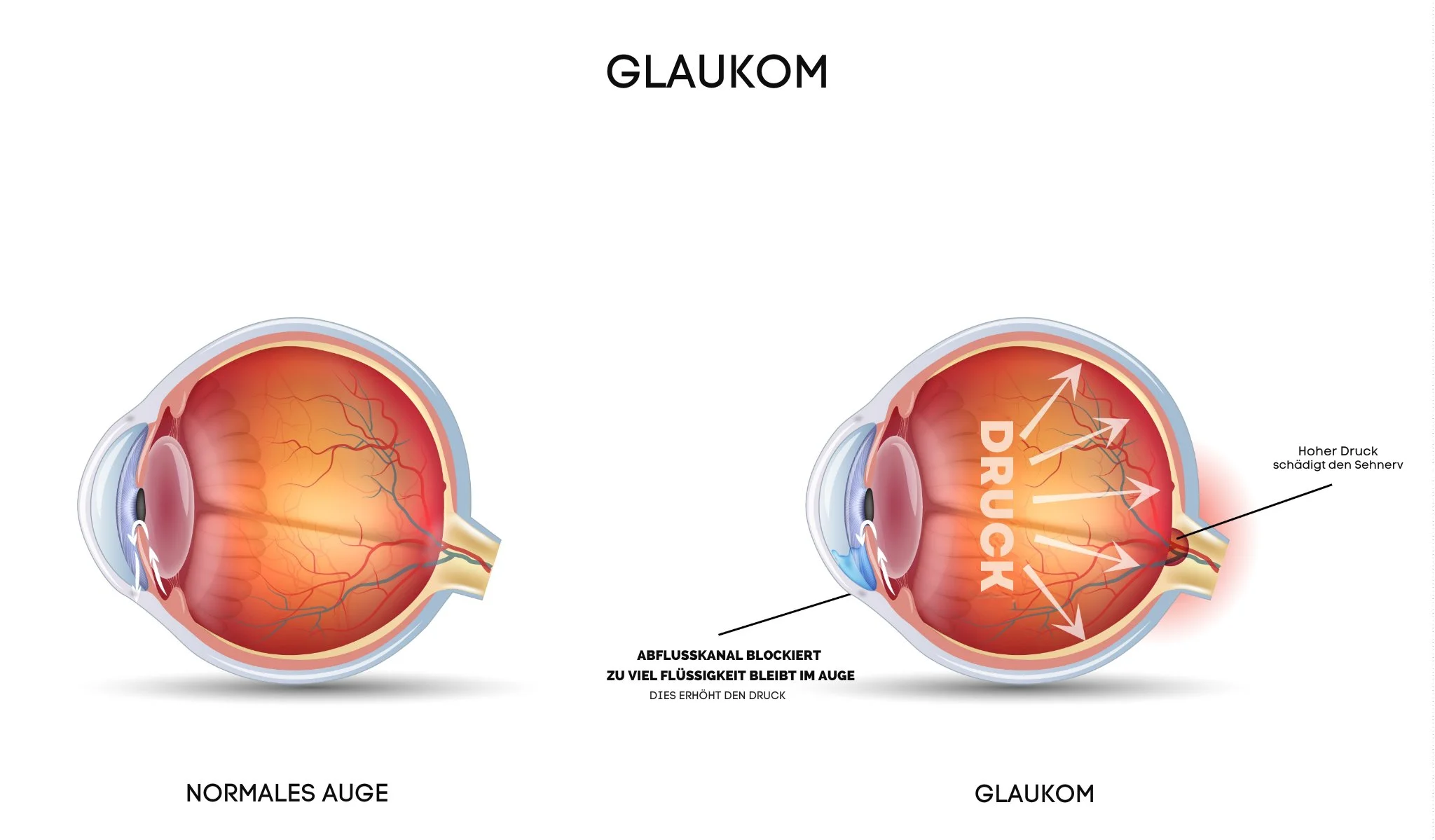 Glaukom
